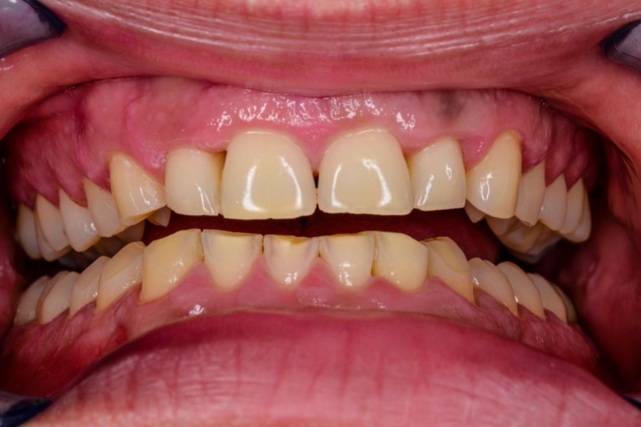 denti consumati